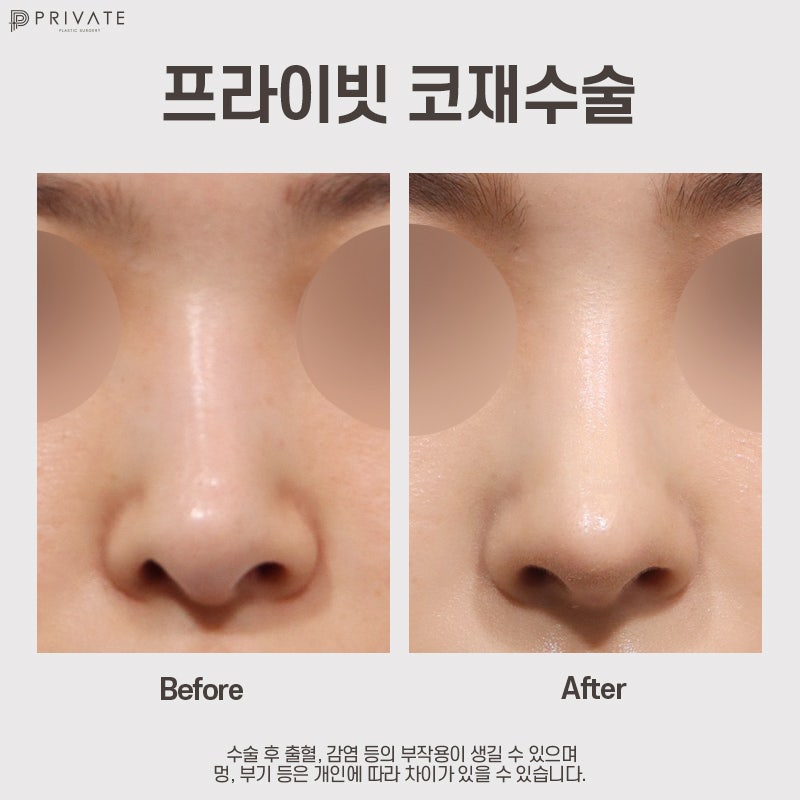 Tempat terbaik untuk operasi hidung revisi adalah Private Plastic Surgery 사진 9