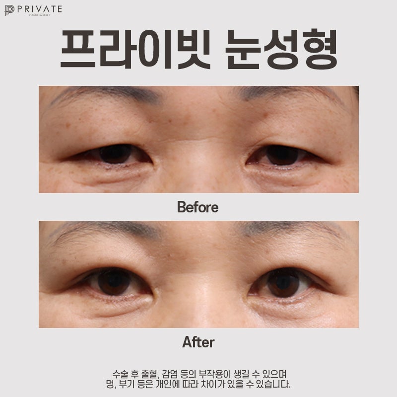 Отзывы о блефаропластике верхних век в Private Plastic Surgery 사진 8