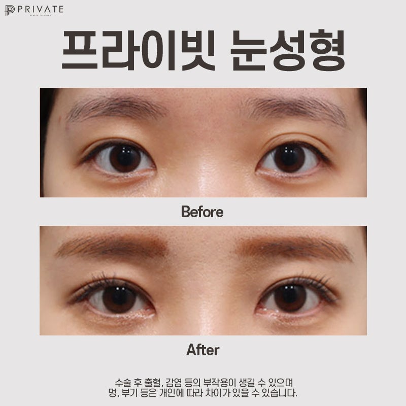 Let's explore natural adhesion double eyelid surgery at Sinsa Private Plastic Surgery Clinic 사진 8