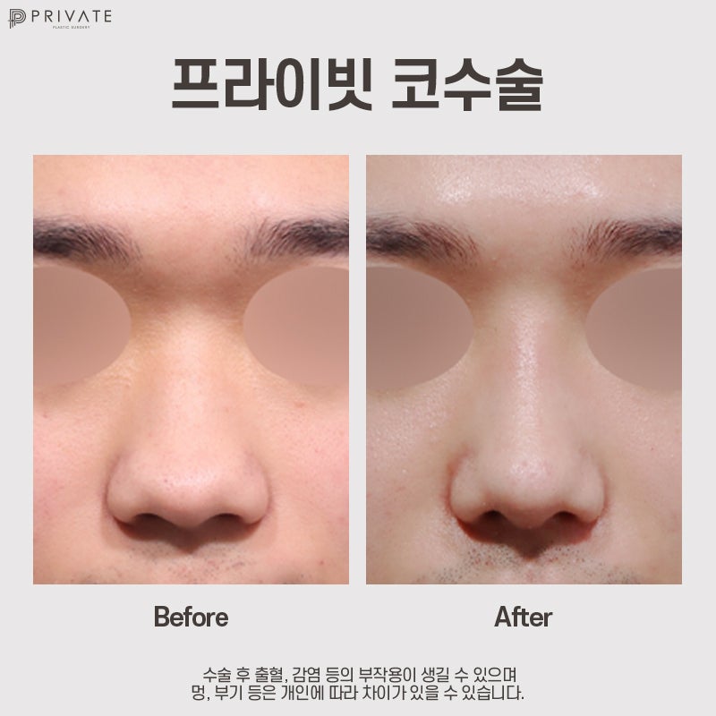 Rumah Sakit Bedah Hidung Pria, Sinsa Private Plastic Surgery 사진 8