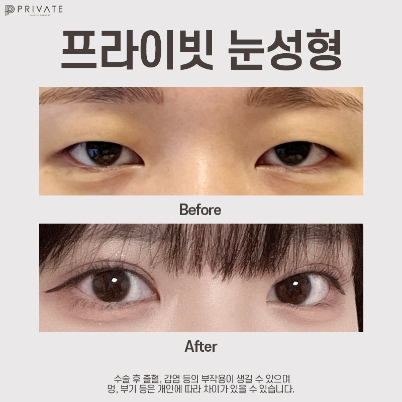 Check out Incision Double Eyelid Surgery Reviews at Sinsa Private Plastic Surgery Clinic 사진 8