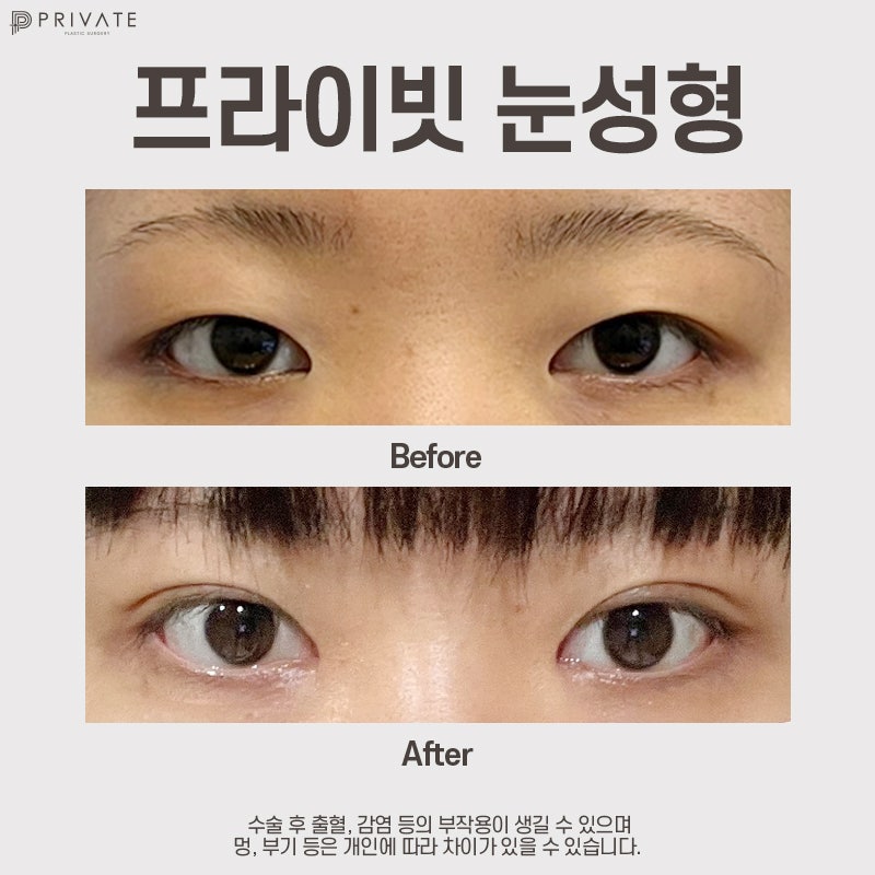 Check out Incision Double Eyelid Surgery Reviews at Sinsa Private Plastic Surgery Clinic 사진 7