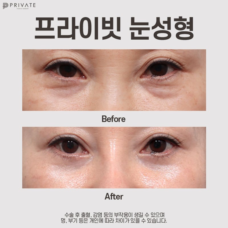 Operasi Blefaroplasti Bawah Mata di Sinsa Private Plastic Surgery 사진 8