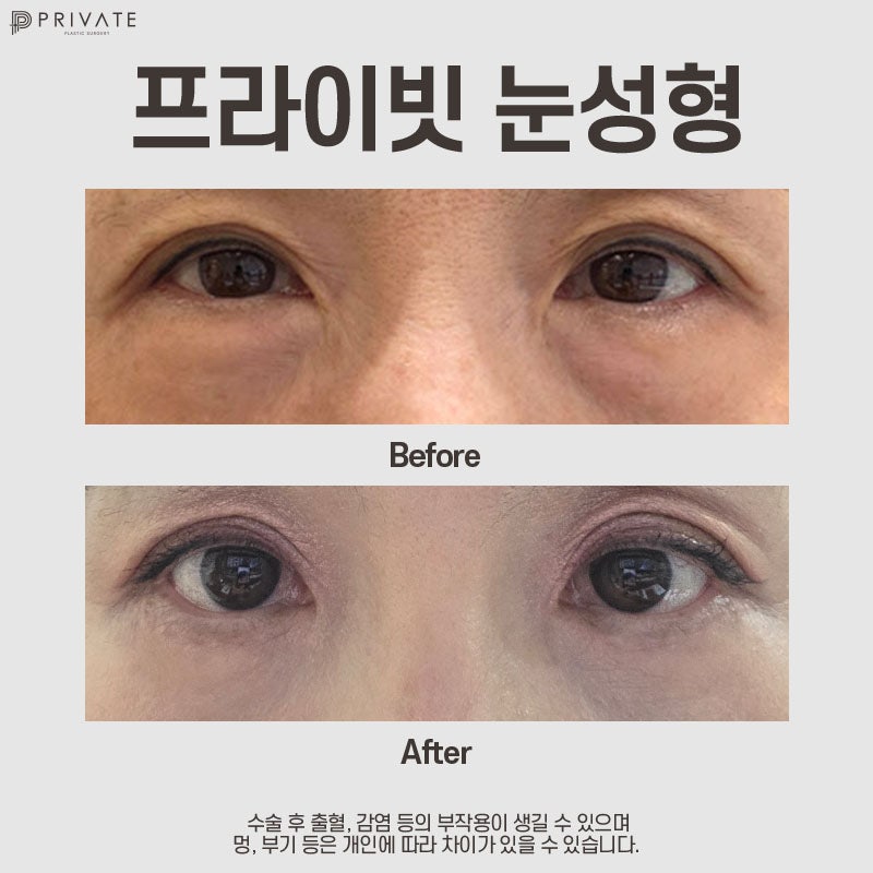 Operasi Blefaroplasti Bawah Mata di Sinsa Private Plastic Surgery 사진 7
