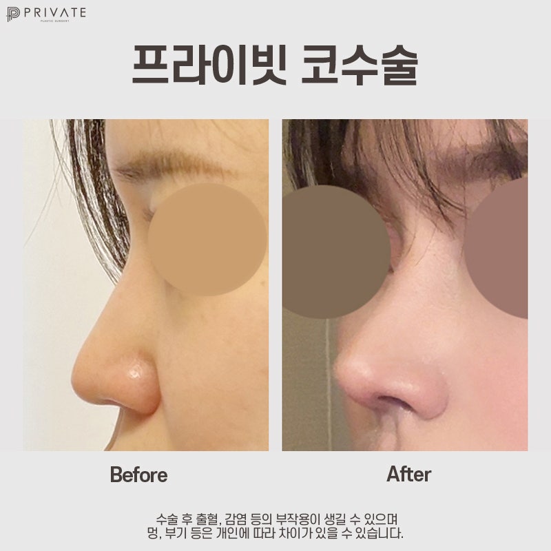 긴코 수술 후기 좋은 프라이빗성형외과 사진 9