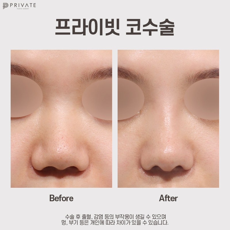 복코 성형외과는 신사 프라이빗성형외과 사진 7
