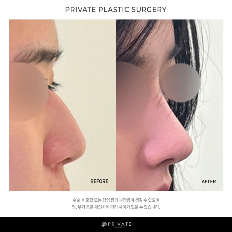 신사 프라이빗성형외과 매부리코교정 잘하는곳 사진 8