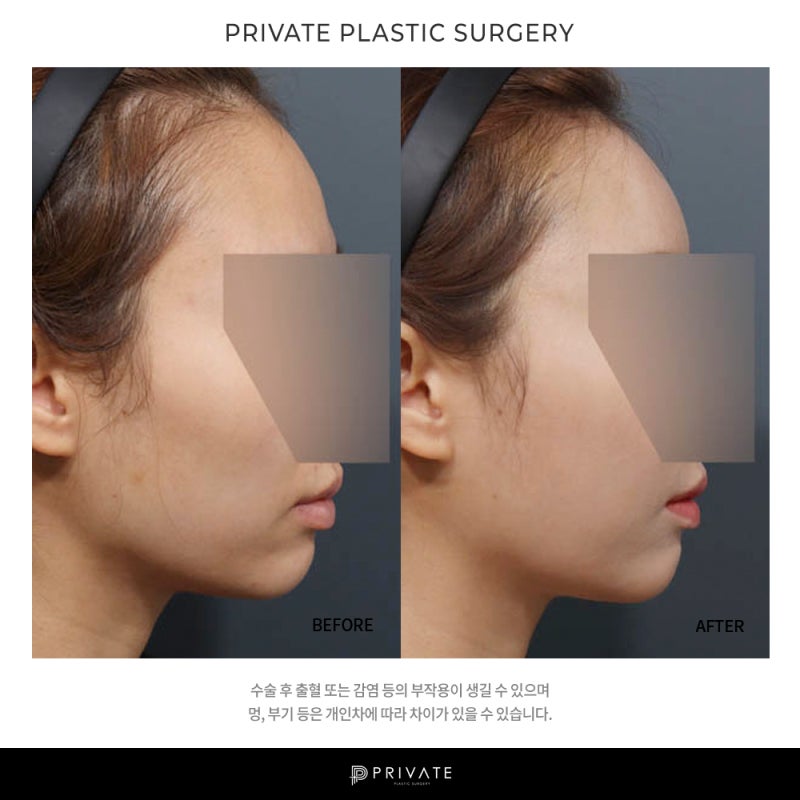 มาทำความรู้จักกับการศัลยกรรมปลูกถ่ายไขมันที่ Private Plastic Surgery กันเถอะ 사진 8