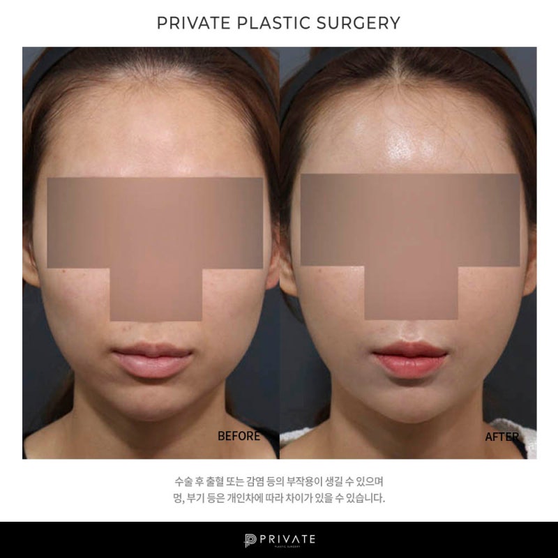 มาทำความรู้จักกับการศัลยกรรมปลูกถ่ายไขมันที่ Private Plastic Surgery กันเถอะ 사진 7
