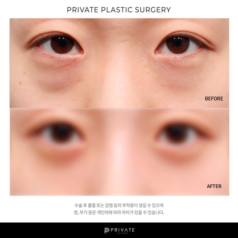 프라이빗 성형외과 눈밑지방재배치 사진 9