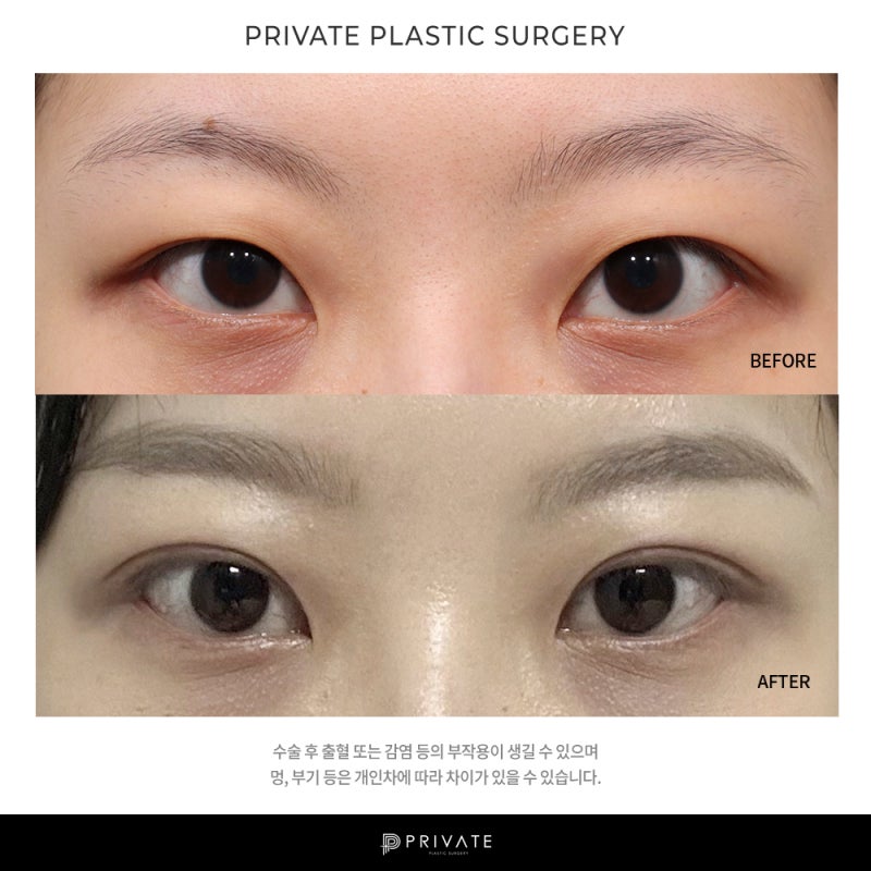 프라이빗 성형외과 쌍수 알아보자 사진 10