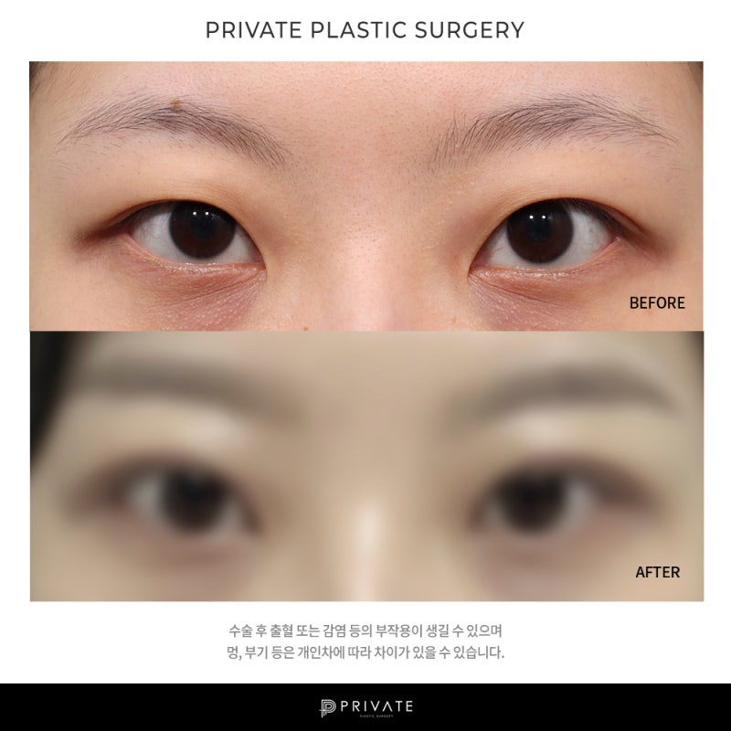 프라이빗 성형외과 쌍수 알아보자 사진 9