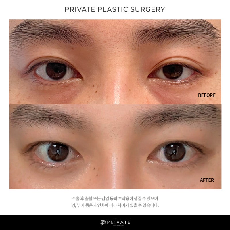 프라이빗 성형외과 남자눈매교정 알아보자 사진 11