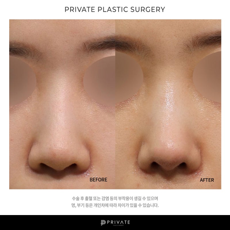 프라이빗 성형외과 코재수술 알아보기 사진 8