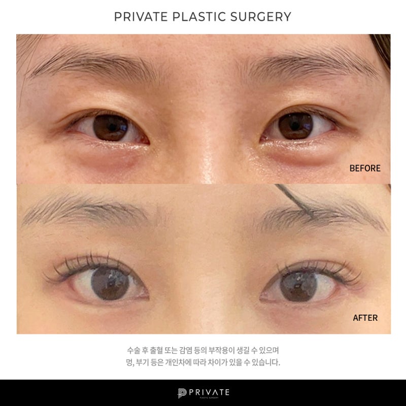 프라이빗 성형외과 쌍커풀 확인해보기 사진 8