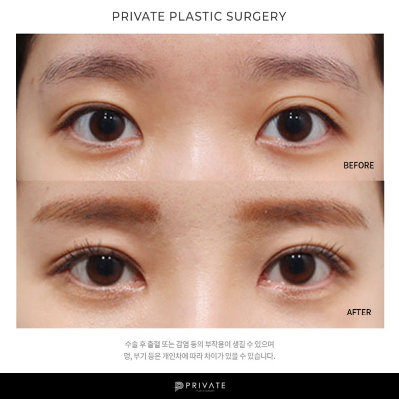 프라이빗 성형외과 쌍커풀 확인해보기 사진 7