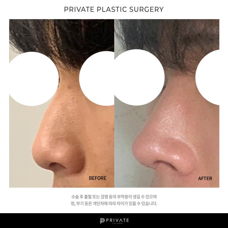 프라이빗 성형외과 남자 코수술 후기 좋은곳이네 사진 9