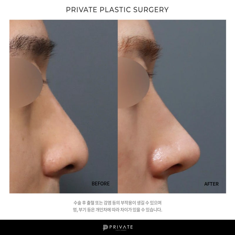 프라이빗 성형외과 남자 코수술 후기 좋은곳이네 사진 11