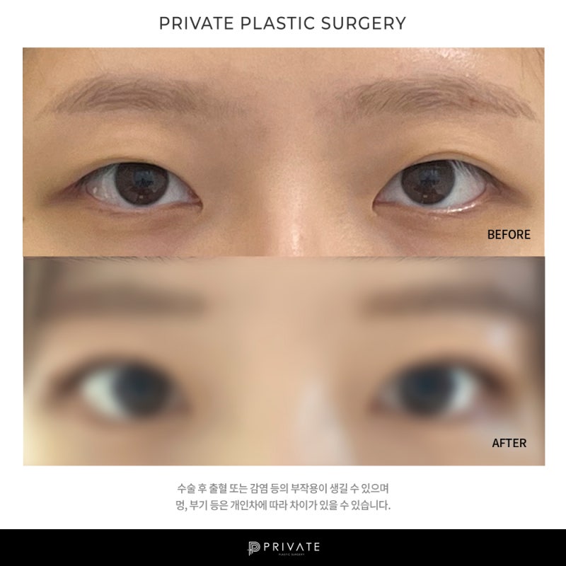 프라이빗 성형외과 눈 재수술 알아보자 사진 9