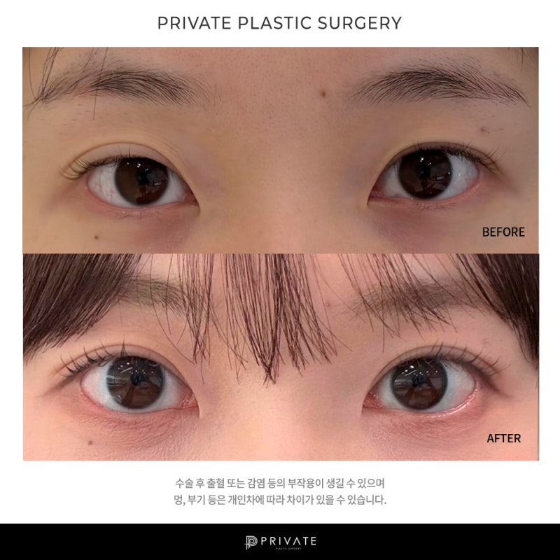 프라이빗 성형외과 눈 재수술 알아보자 사진 8